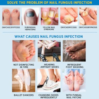 Toenail Fungus Treatment Extra Strength - 32 Patches with Hydrogel for Overnight Repair Fungus Nail Treatment For Toenail - Nighttime Fungal Nail Patches Visible Results in 8 Hours